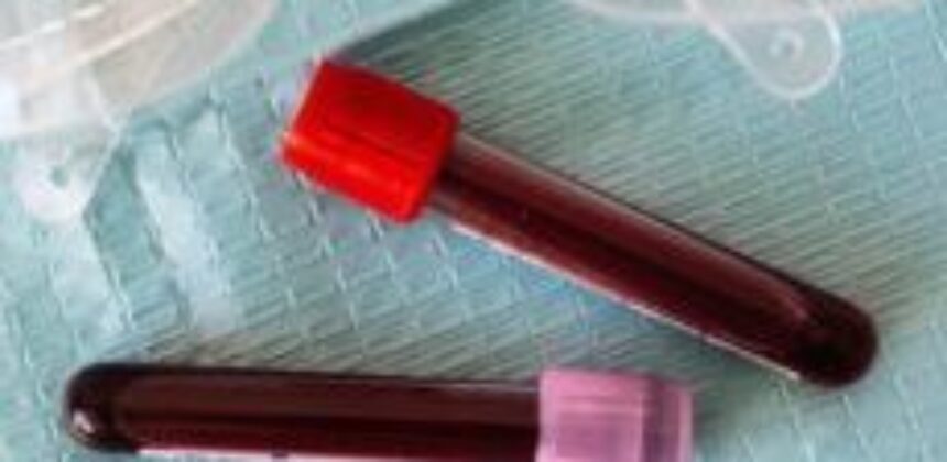 Long-Term Effects of Alcohol on the Liver